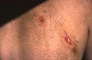 bear claw wounds in right shoulder