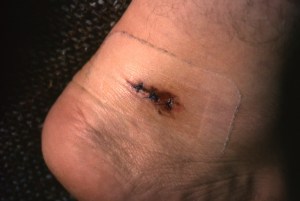 a bite mark from a bear on my heel